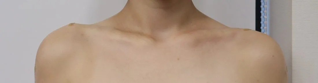 Collarbone filler after — Barog Clinic
