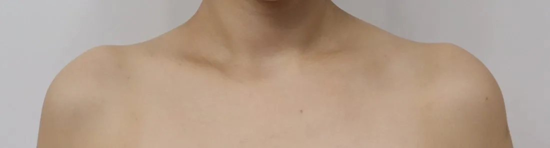 Collarbone filler before — Barog Clinic